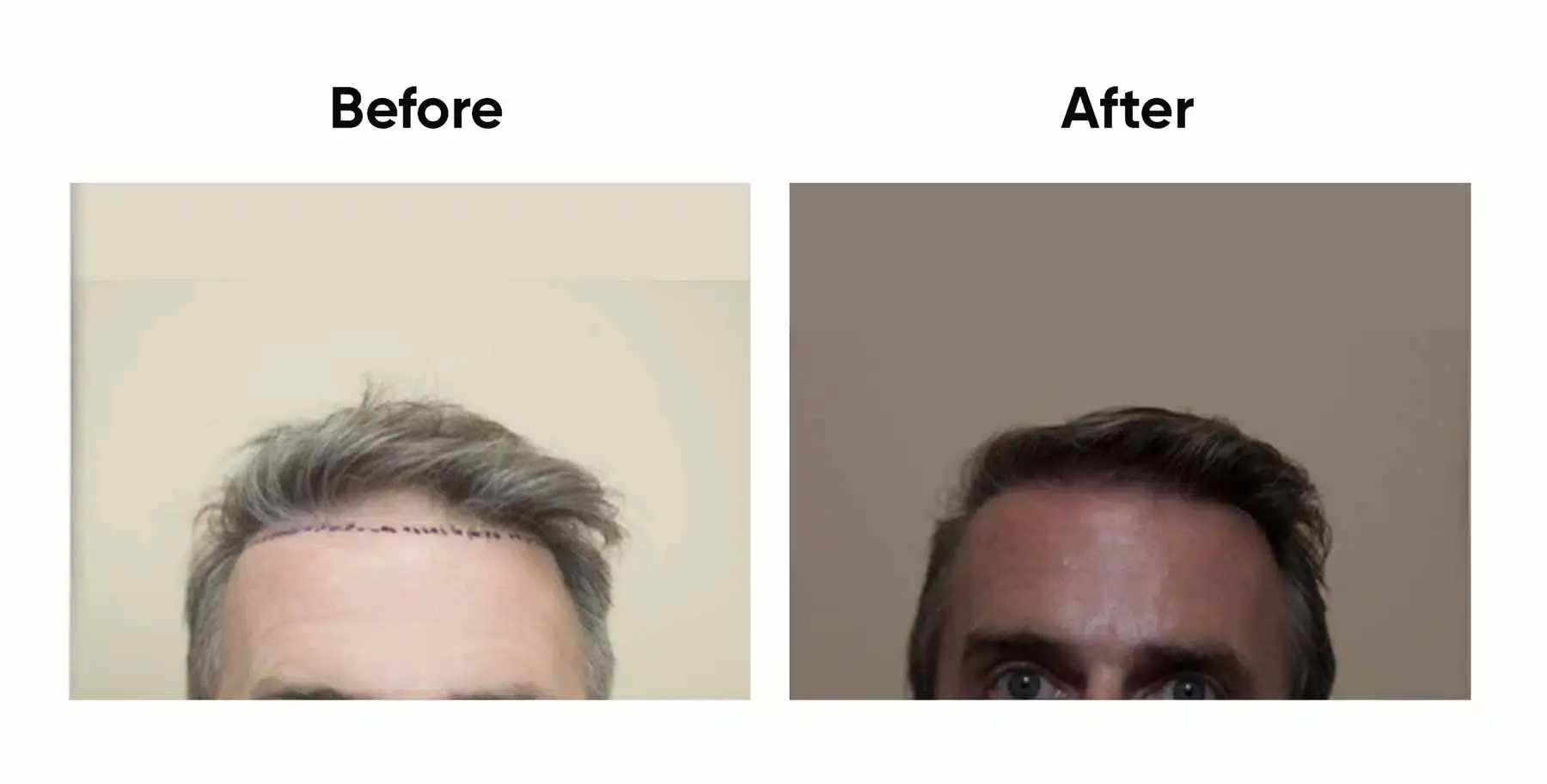 Hair transplant before and after