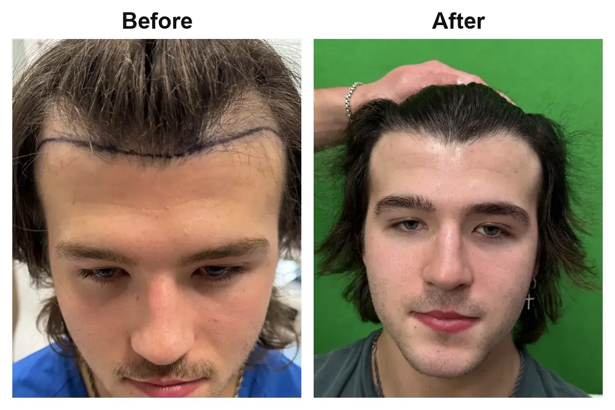 Hair transplant before and after
