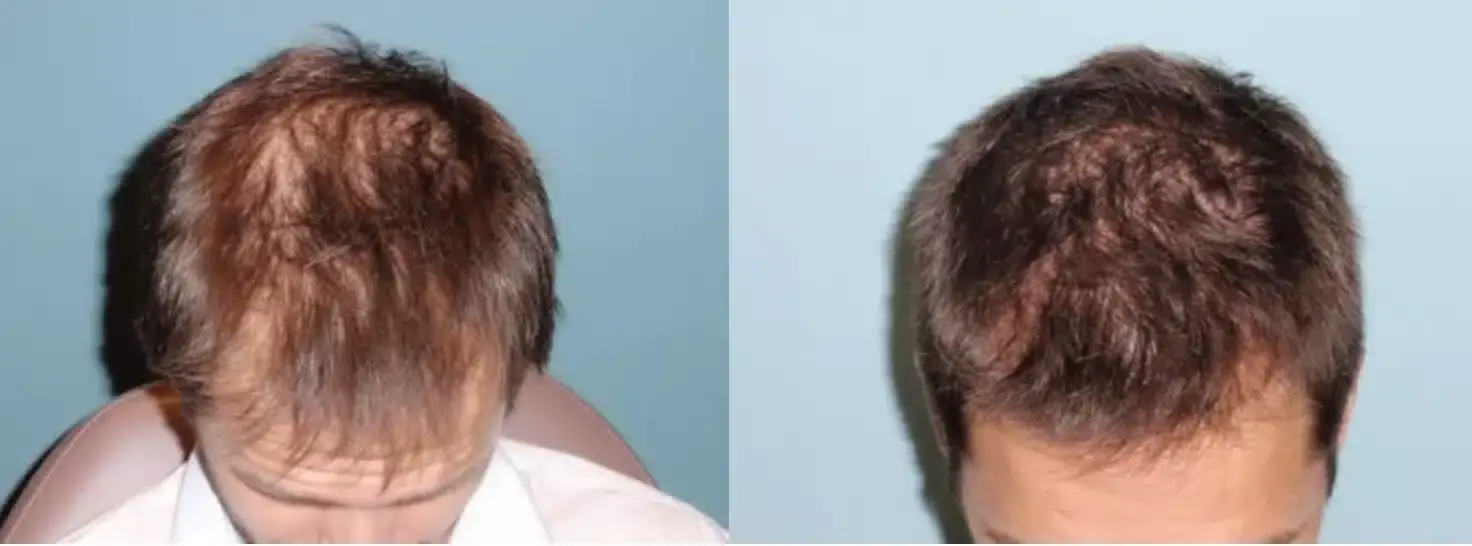 SmartGraft before and after