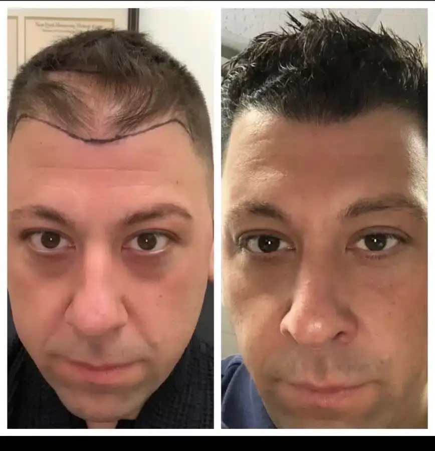 Hair transplant before and after