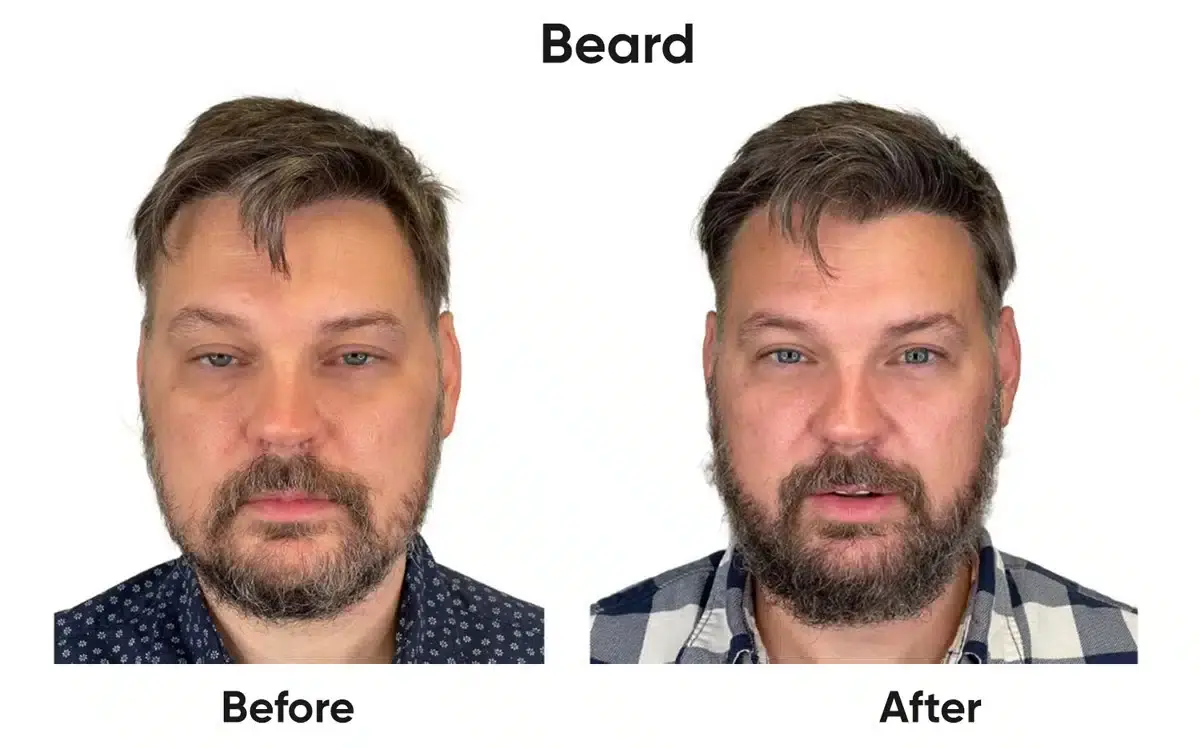 Beard transplant before and after