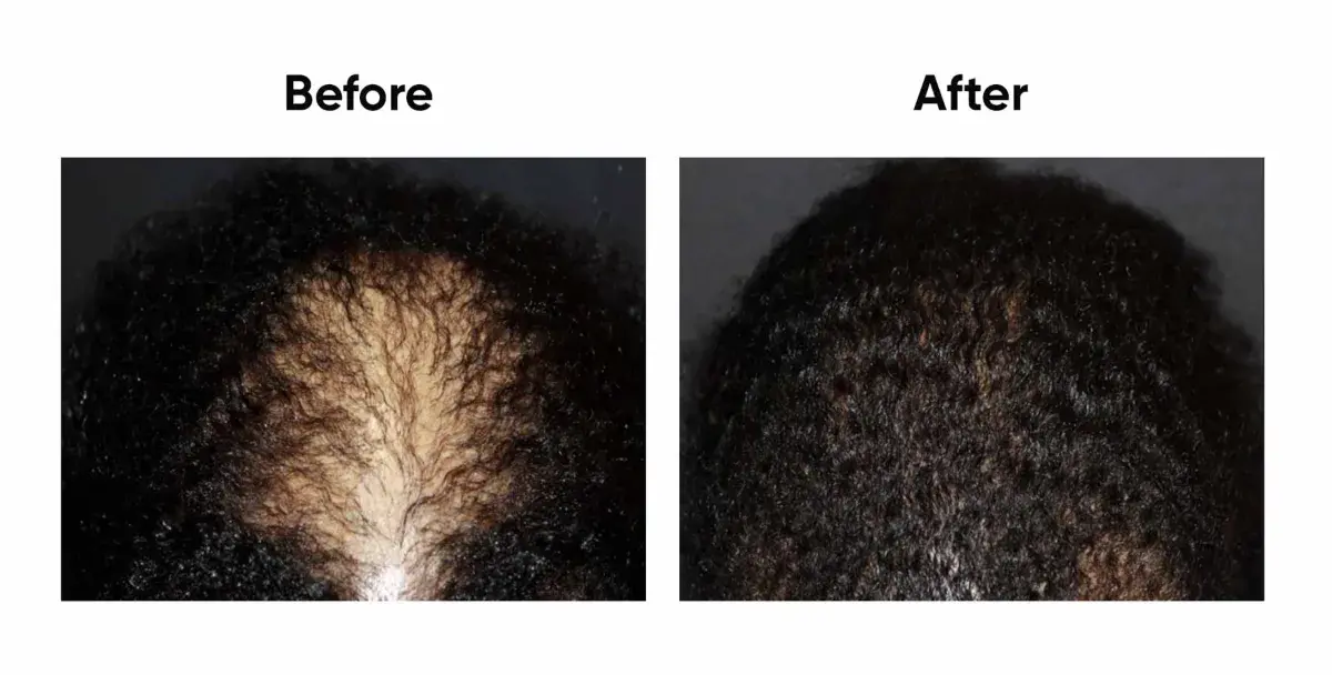 Hair transplant before and after
