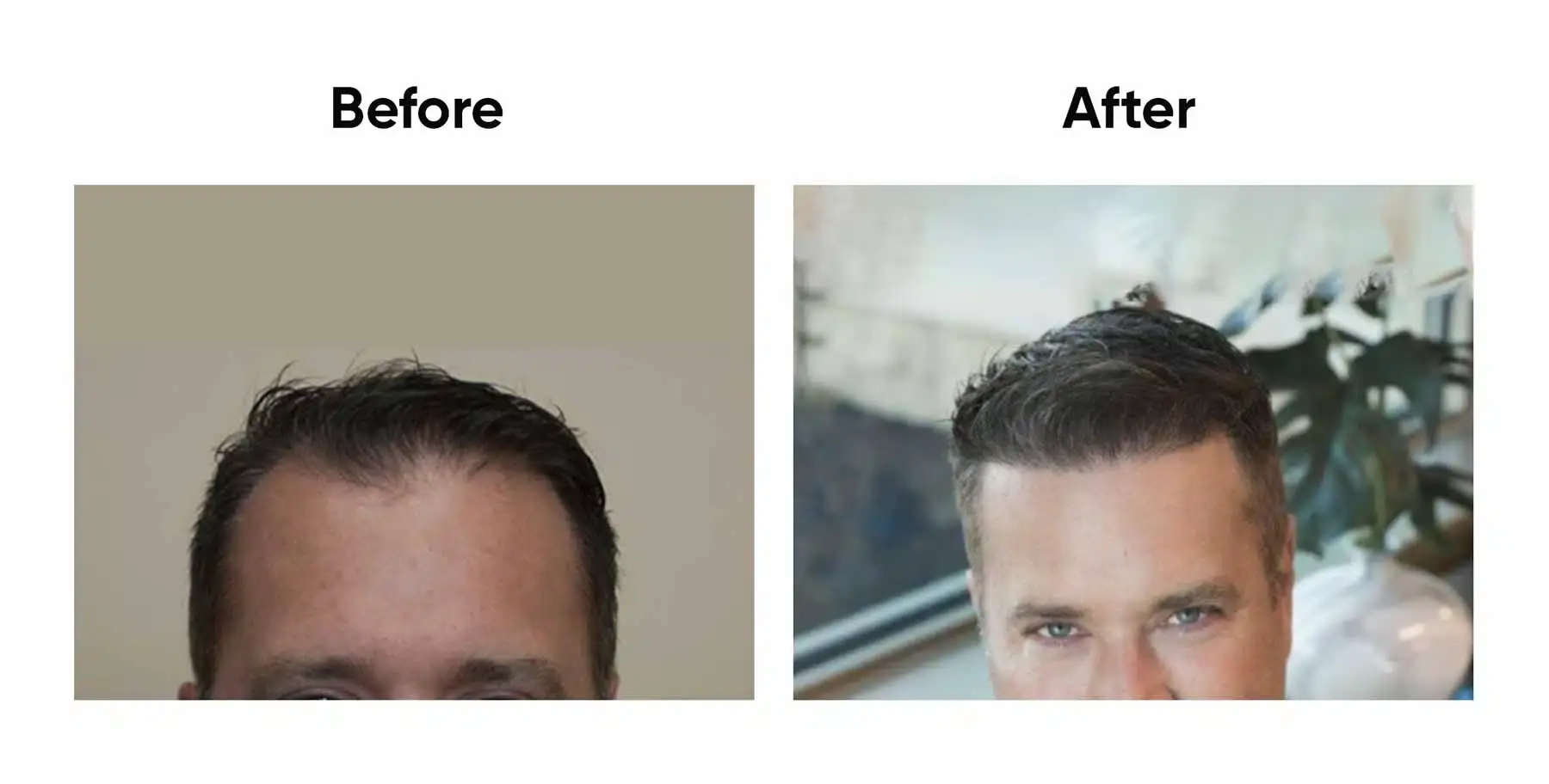 Hair transplant before and after