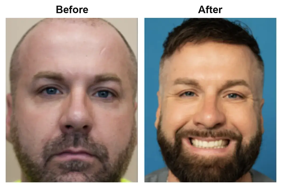 Hair transplant before and after