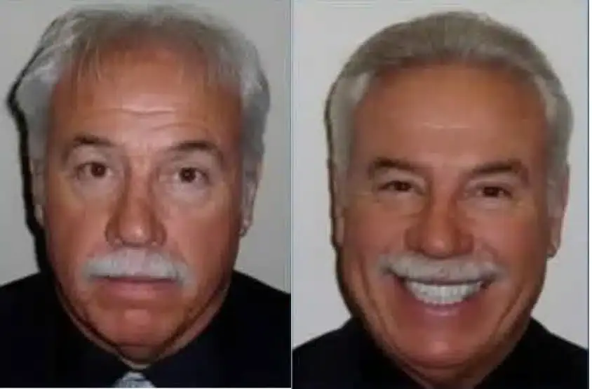 SmartGraft before and after