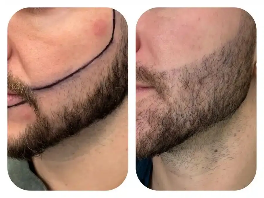 Hair transplant before and after