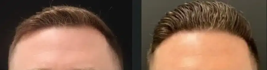 Hair transplant before and after