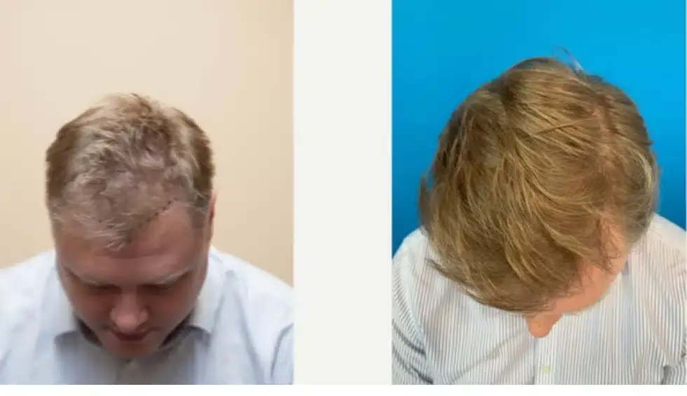 SmartGraft before and after