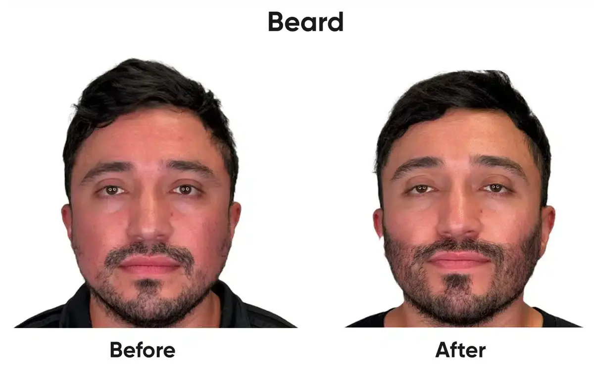 Beard transplant before and after
