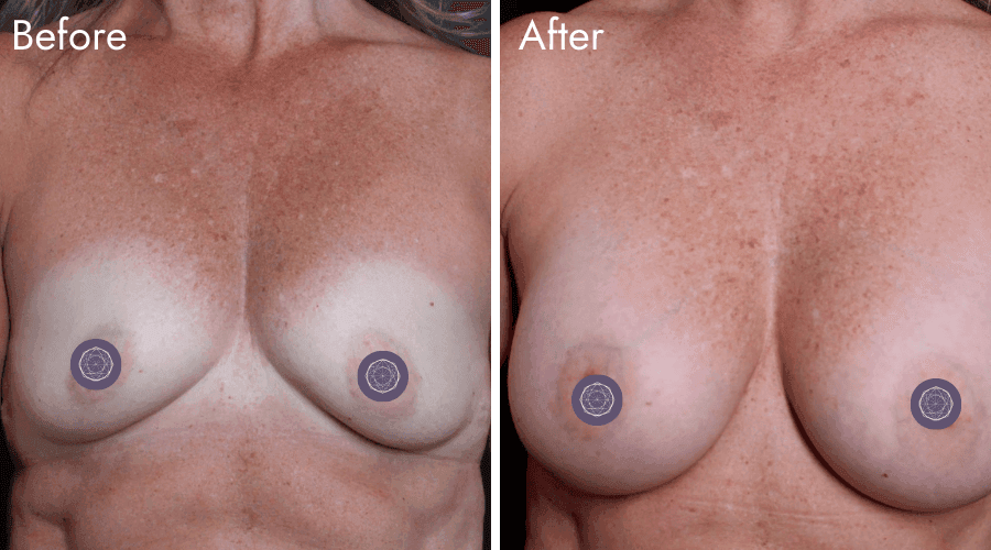patient 4 before after