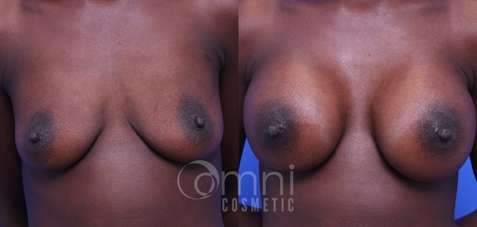 Front view of patient before and after breast augmentation in Wayzata, MN at Omni Cosmetic by Dr. Miles Bichanich.